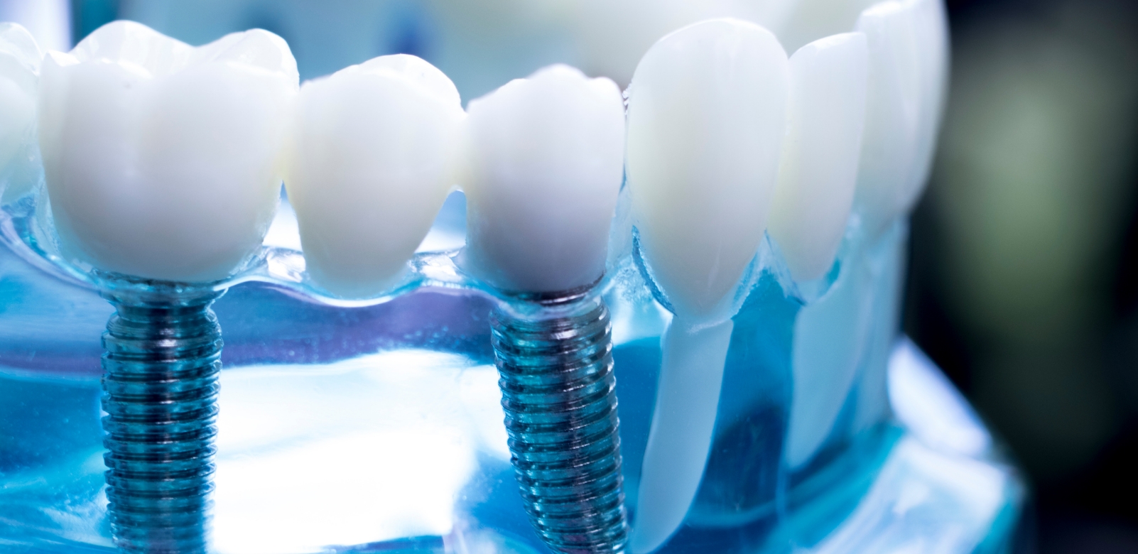 Dental Implant Treatment