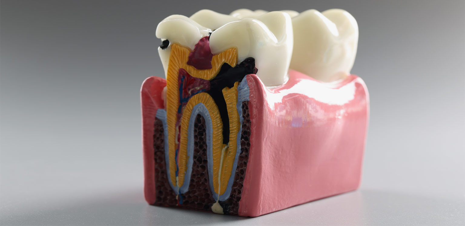 root-canal-image