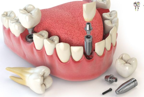 Types of Dental Implants