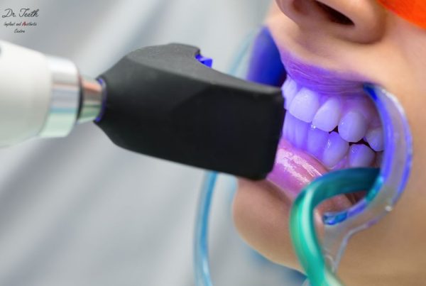 Teeth Whitening