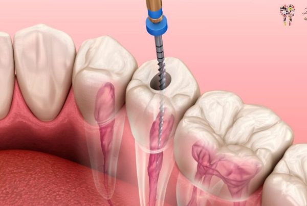 Root Canal Treatment