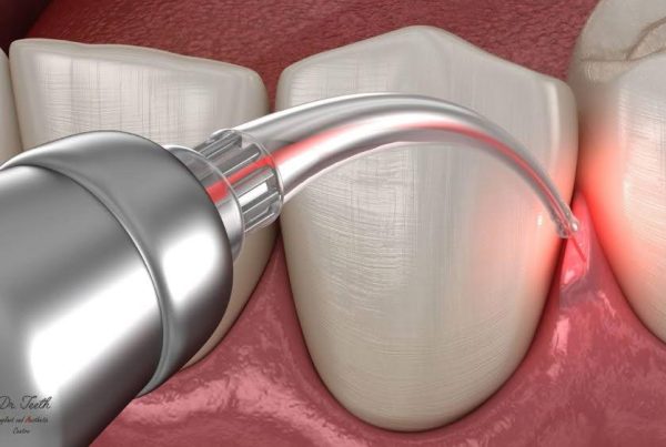 The Pros and Cons of Laser Dentistry