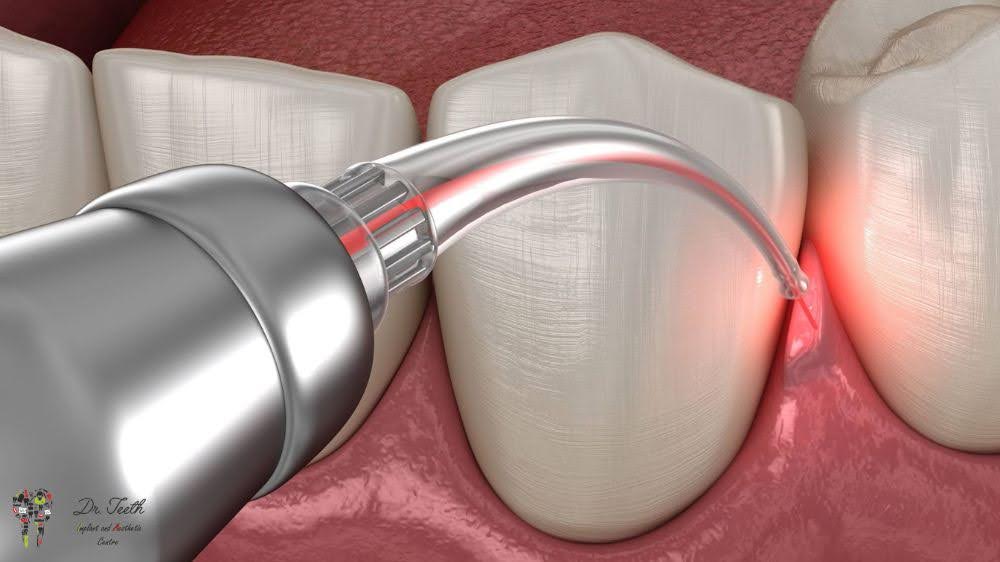 The Pros and Cons of Laser Dentistry