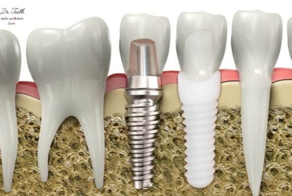Titanium vs Zirconia Dental Implants