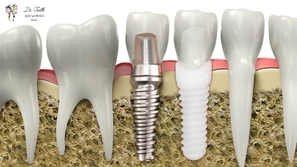 Titanium VS. Zirconia Dental Implants: Which One is Right for You?