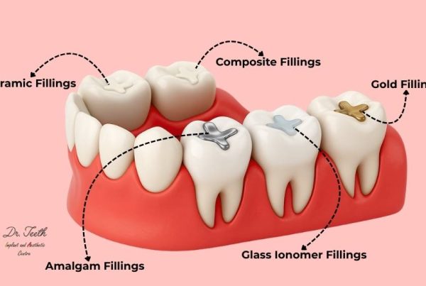 dental filling types