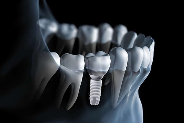 Why New Zealanders Are Choosing Mumbai, India for Dental Implants