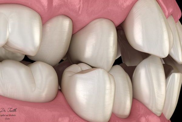 Crooked Teeth