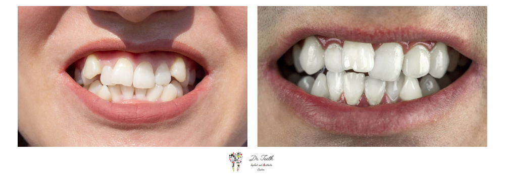 Crooked Teeth