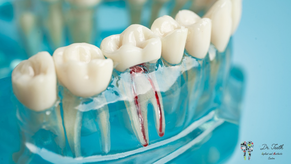 about root canal treatment