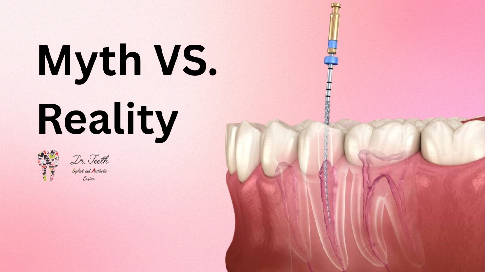 Root Canal Treatment: Myth vs. Reality