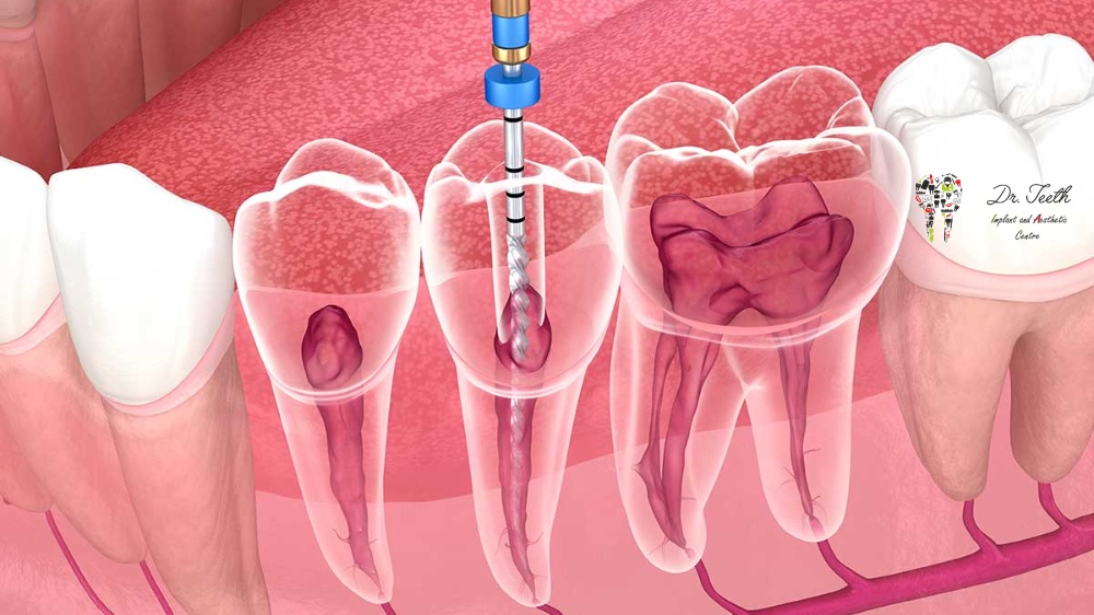 tips for patients before and after root canal