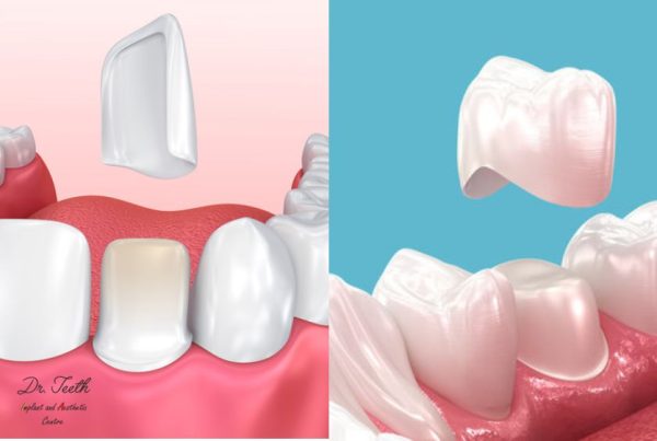 Veneers-vs.-Crowns