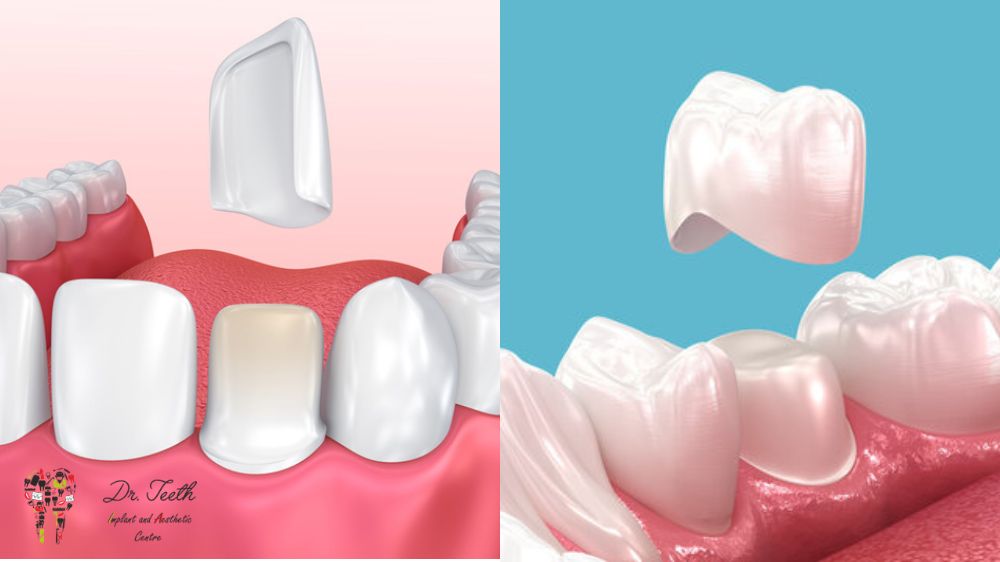 Veneers vs. Crowns: Which Cosmetic Solution is Right for You?
