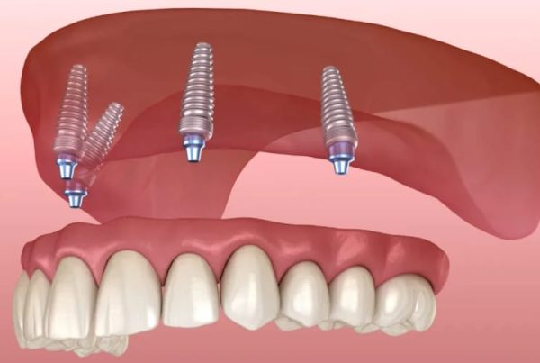 What Are All-on-4 Dental Implants?