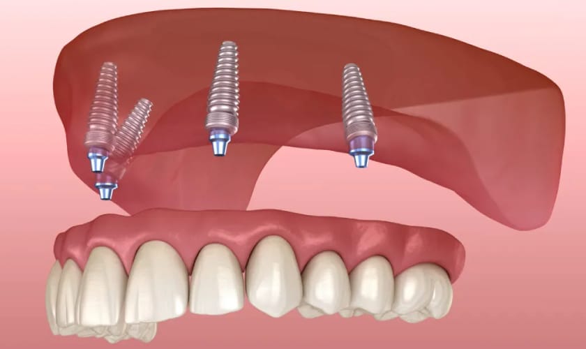 All-on-4 Dental Implants – Groundbreaking Full Mouth Implant Technique