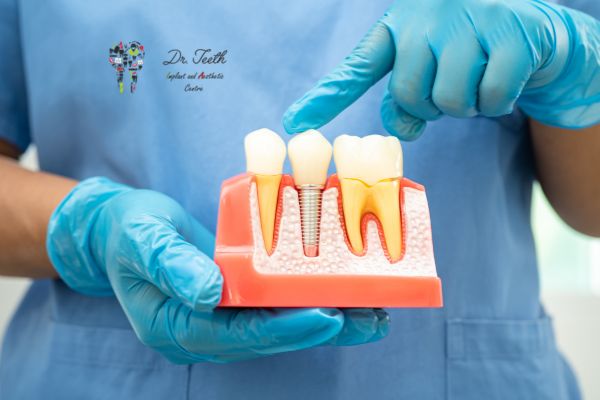 Is a Root Canal Considered Surgery Everything You Need to Know