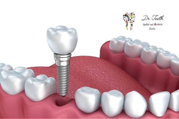 Can You Get a Single Tooth Implant