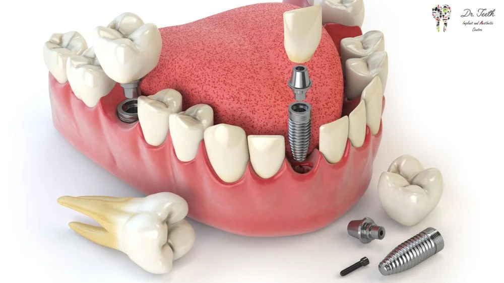 Types of Dental Implants: A Beginner’s Guide