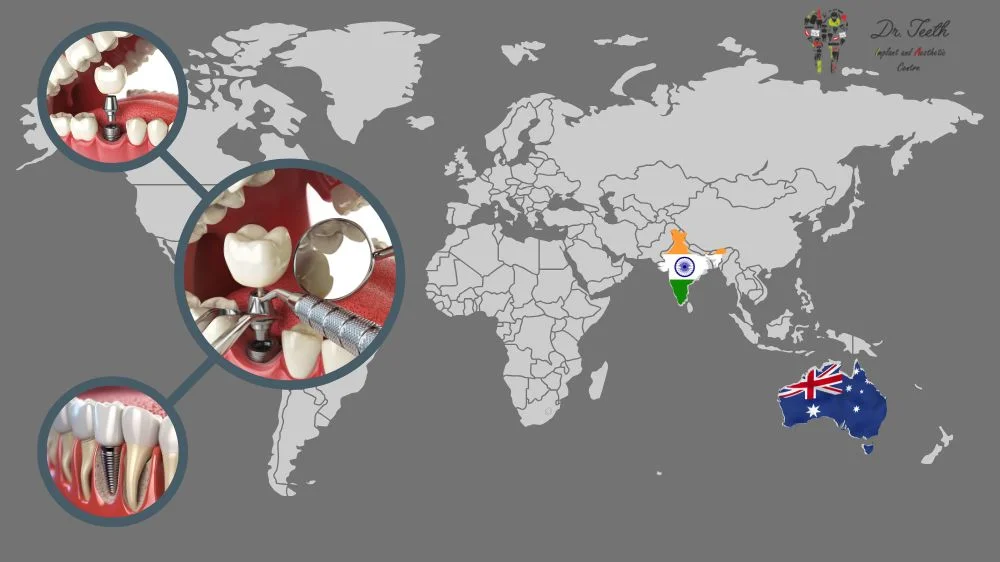 Dental Implants in Australia vs India