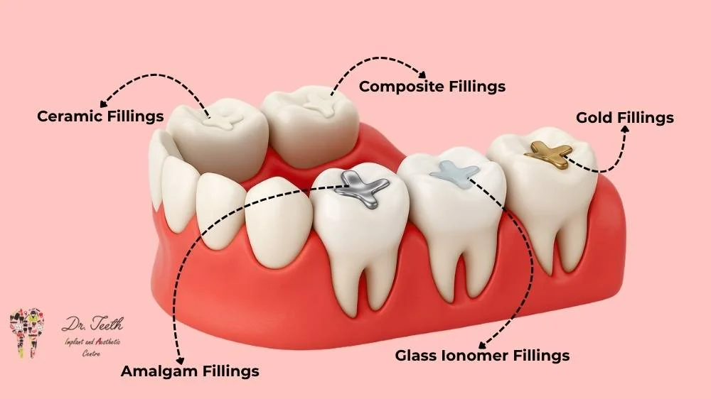 Dental Filling Types: Materials, Benefits & How to Choose the Right One