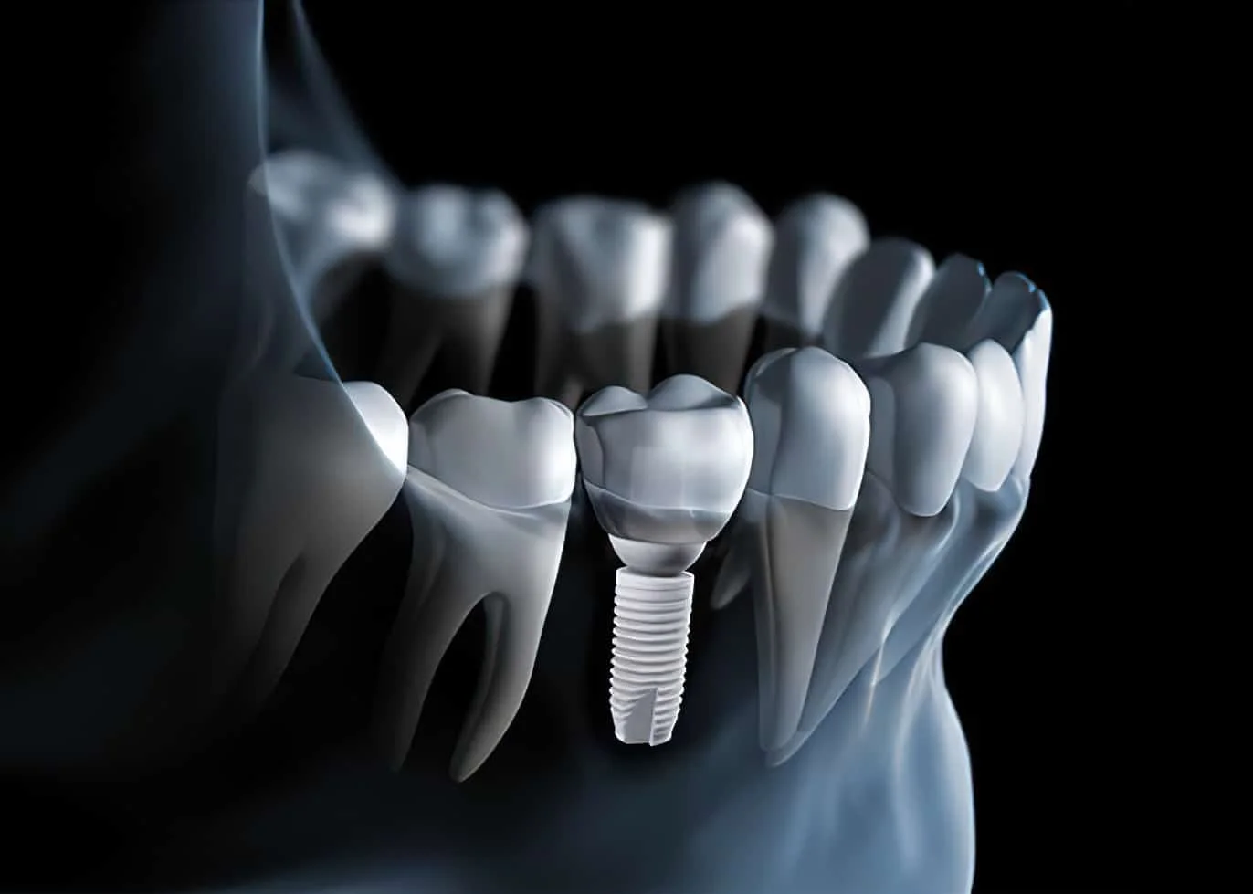 Why New Zealanders Are Choosing Mumbai, India for Dental Implants