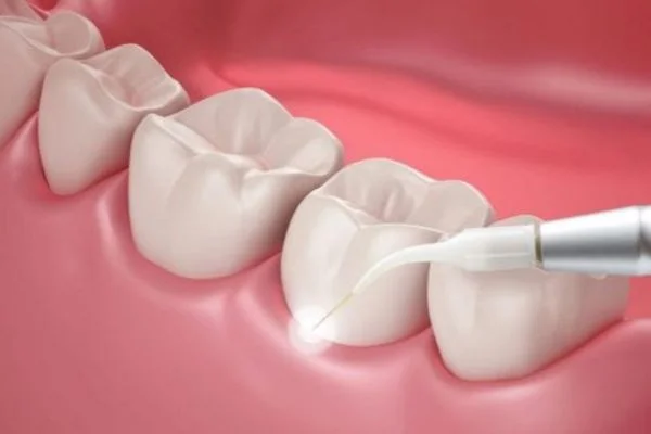 What Is Laser Gum Treatment?