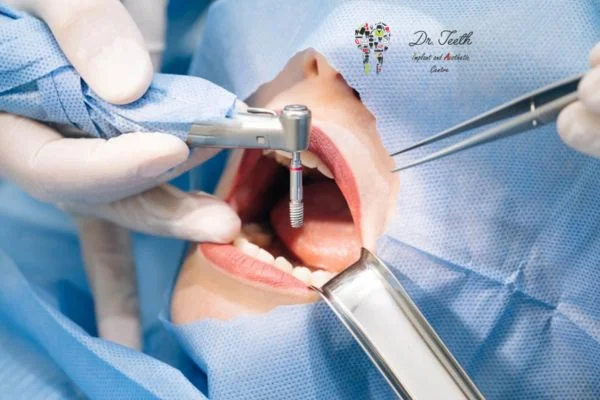 Teeth Surgery Types: A Complete Guide